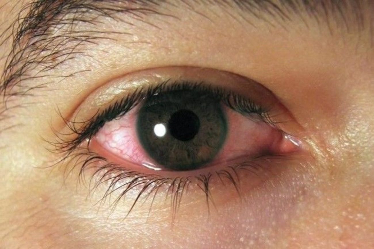 Ojos secos